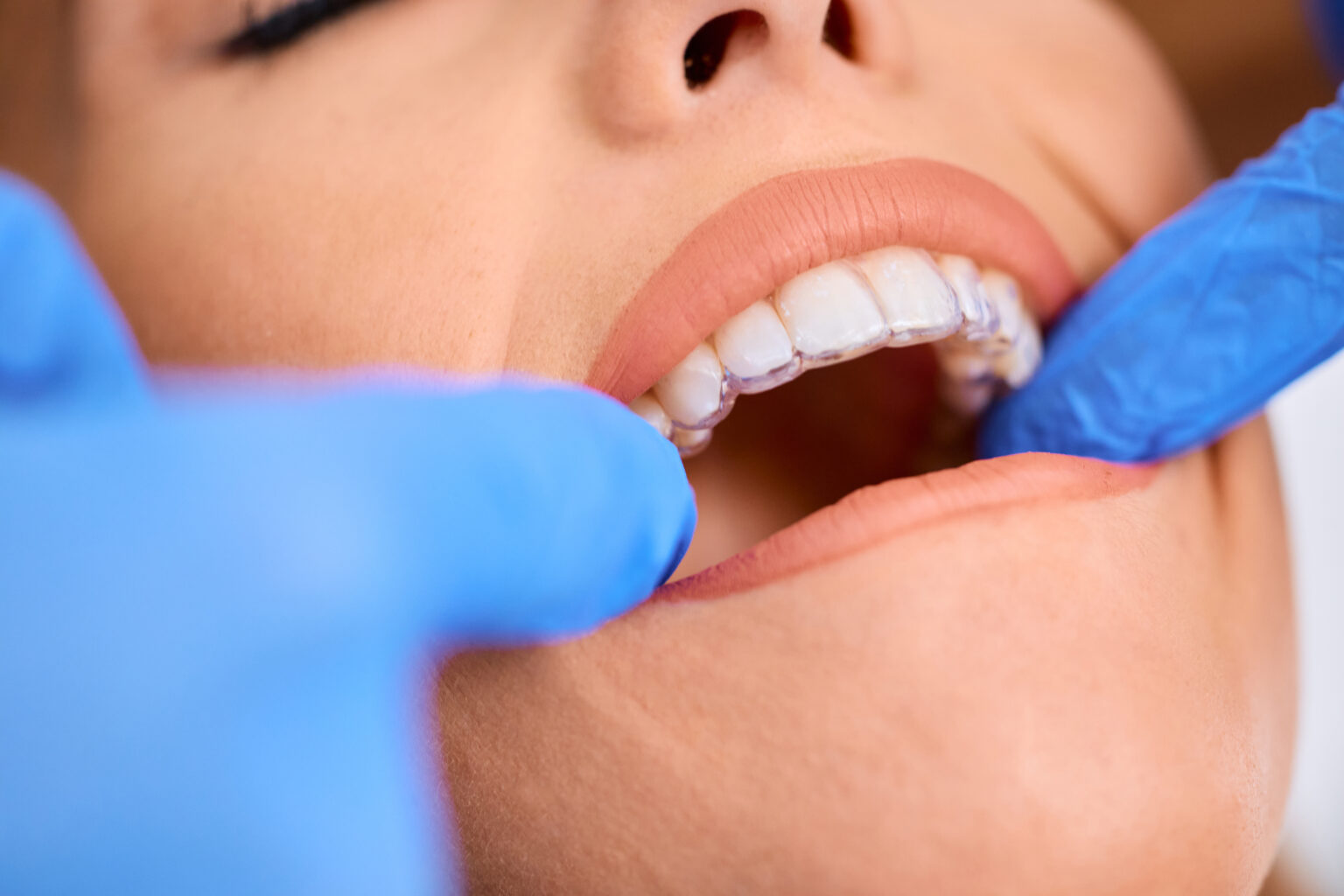 Different Types of Braces